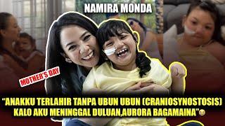 NAMIRA MONDA "ANAKKU TERLAHIR TANPA UBUN UBUN  (CRANIOSYNOSTOSIS)..”