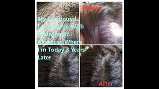 My Continued Long Battle with Androgenic Alopecia and Where I am Today After 3 Years