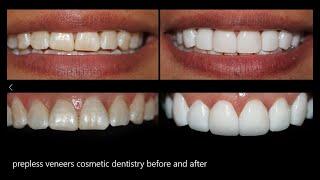 Prepless Veneers Cosmetic Dentistry Before and After.