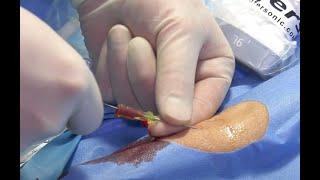 Radial artery line insertion