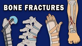 BONE FRACTURES