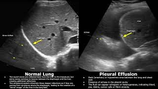 Lung Ultrasound Normal Vs Pleural Effusion Image Appearances | Thoracic Spine, Quad & Sinusoid Signs