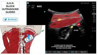 G.O.N. BLOCK ULTRASOUND GUIDED