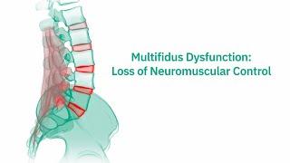 Multifidus Dysfunction: Loss of Neuromuscular Control