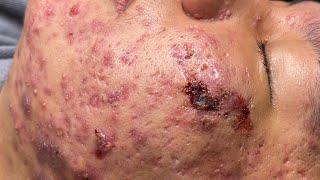 Blackheads & Pimples Pore Removal New 2024[FULL] | Acne Treatment With  Bo Nguyễn Spa