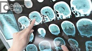 How to identify Multiple Sclerosis & what are its MRI findings? - Dr. Vykunta Raju K N