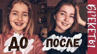 СНЯЛИ БРЕКЕТЫ !! // моя история // как все происходило?