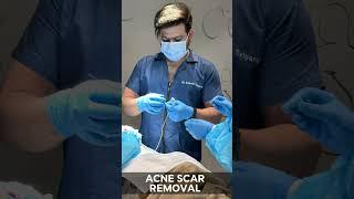 Acne Scar Removal by Dr. Adarsh Tripathi