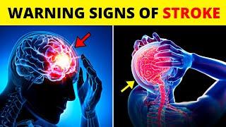 10 Warning Signs of Stroke One Month BEFORE It Happens | Health Tutor