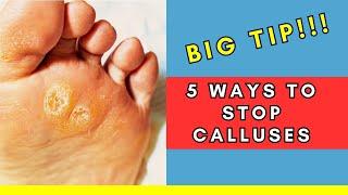 STOP Calluses: 5 Steps to Prevent Them from Returning (Podiatrist Tips!) | BONUS clinic strategy