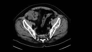 Appendix Mucocele