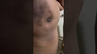 Seroma after gynecomastia surgery