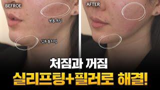 이중턱 실리프팅& 턱선 실리프팅& 눈밑 필러 알아두면 젊어지는 시술
