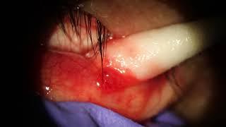 Chalazion Popped on inner eyelid w needle