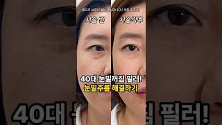 40대 눈밑꺼짐필러 시술전후 (#눈밑필러)-#shorts