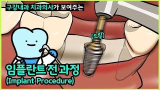 임플란트 과정, 임플란트수술 한국인이 좋아하는 속도로 (Implant procedure, Implant surgery, 임플란트 식립, 임플란트 전 과정 종류와 기구까지)