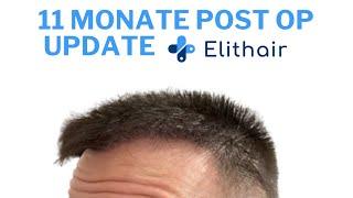 Haartransplantation bei Elithair - Status Update 11 Monate Post OP