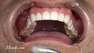 Prepless porcelain dental veneers cosmetic dentistry - San Antonio, TX