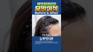2025년 최신 동안비율! 참닥터 헤어라인교정!