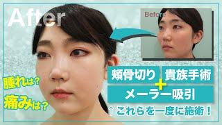 頬骨切り＋貴族手術＋メーラー吸引を一度に！気になる腫れや痛みは？｜WOM CLINIC GINZA（ワムクリニックギンザ)