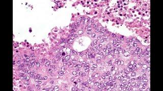 Clear cell hidradenocarcinoma McKee