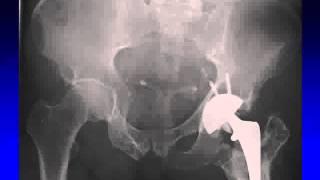 The Role of Ceramic THR in the Management of Hip Arthritis in the Young Adult