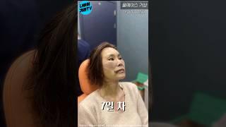 60대 여자 안면거상 #반전주의