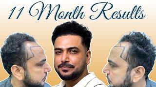 Hair Transplant Success Story – Meet Nawajish | Result after 11 Months | SkinQure