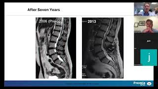 TOPS Facet Replacement--superior solution for lumbar spondylolisthesis & spinal stenosis from Premia