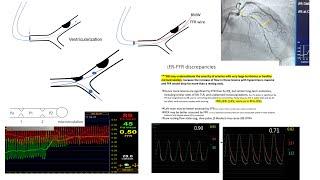 FFR-iFR: concepts, technical pitfalls, applications in various lesion types-Elias hanna