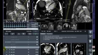 MRI Cardiac..... CMR