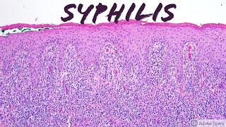 Secondary Syphilis (Lues): 5-Minute Pathology Pearls