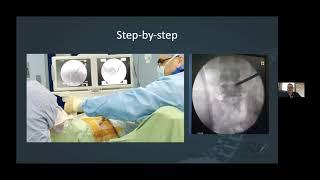 Transforaminal Endoscopic Lumbar Discectomy (TELD)