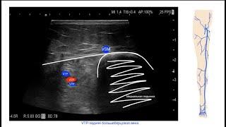 Курс по ультразвуковой Флебологии:"От базы к нюансам"