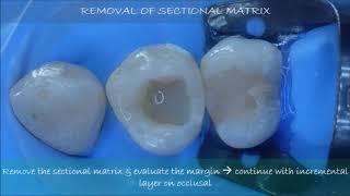Post Endodontic Restoration (Endodontic - Restorative Holistic Treatment) by Aditya Wisnu Putranto