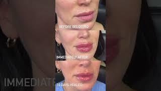 No Filler Lip Filler #lipfiller #injectables #facialaesthetics