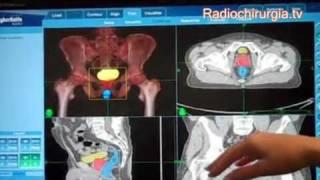 Panoramica sul Cyberknife e Pianificazione del trattamento