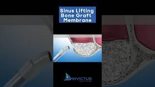 Sinus Lifting + Bone Graft + Membrane