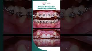 Braces Process for Correcting Crowding