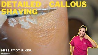 The Unforgettable Impact of Callous Shaving ||  Miss Foot Fixer