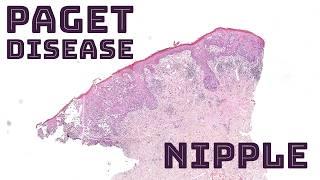 Paget disease (breast cancer in nipple skin - nipple rash/sore/ulcer that won't heal) pathology