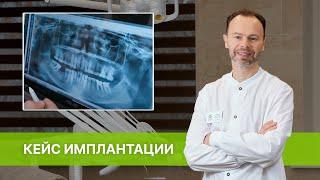 Имплантация зубов в стоматологии РИЦА. План лечения, снимки до и после операции