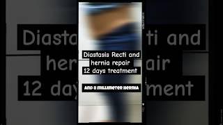 Diastasis Recti and hernia repair after 12 days: Arogya physiotips #diastasisrecti #hernia