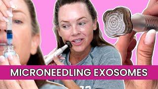 Can Microneedling With Exosomes Erase Wrinkles?