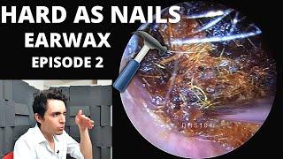 Hard As Nails Ear Wax EPISODE 2