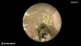 Removing earwax stuck in the ear canal | ENT | Earwax removal | Ear cleaning | Cerumen impaction