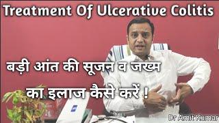 बड़ी आंत की सूजन व जख्म का इलाज कैसे करें ! Treatment Of Ulcerative Colitis