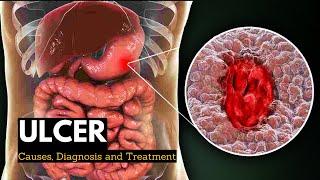 Ulcer, Causes, Signs and Symptoms, Diagnosis and Treatment.