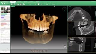 Ez3D i Software - included with the Vatech PaX-i 3D