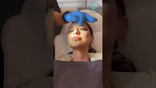 Hastamıza çene botoxu ve burun dolgusu işlemlerini uyguladık. #ckklinik #cemkaras